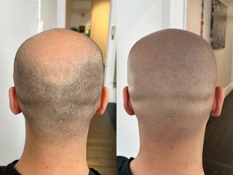 How much money can you make doing scalp micropigmentation?