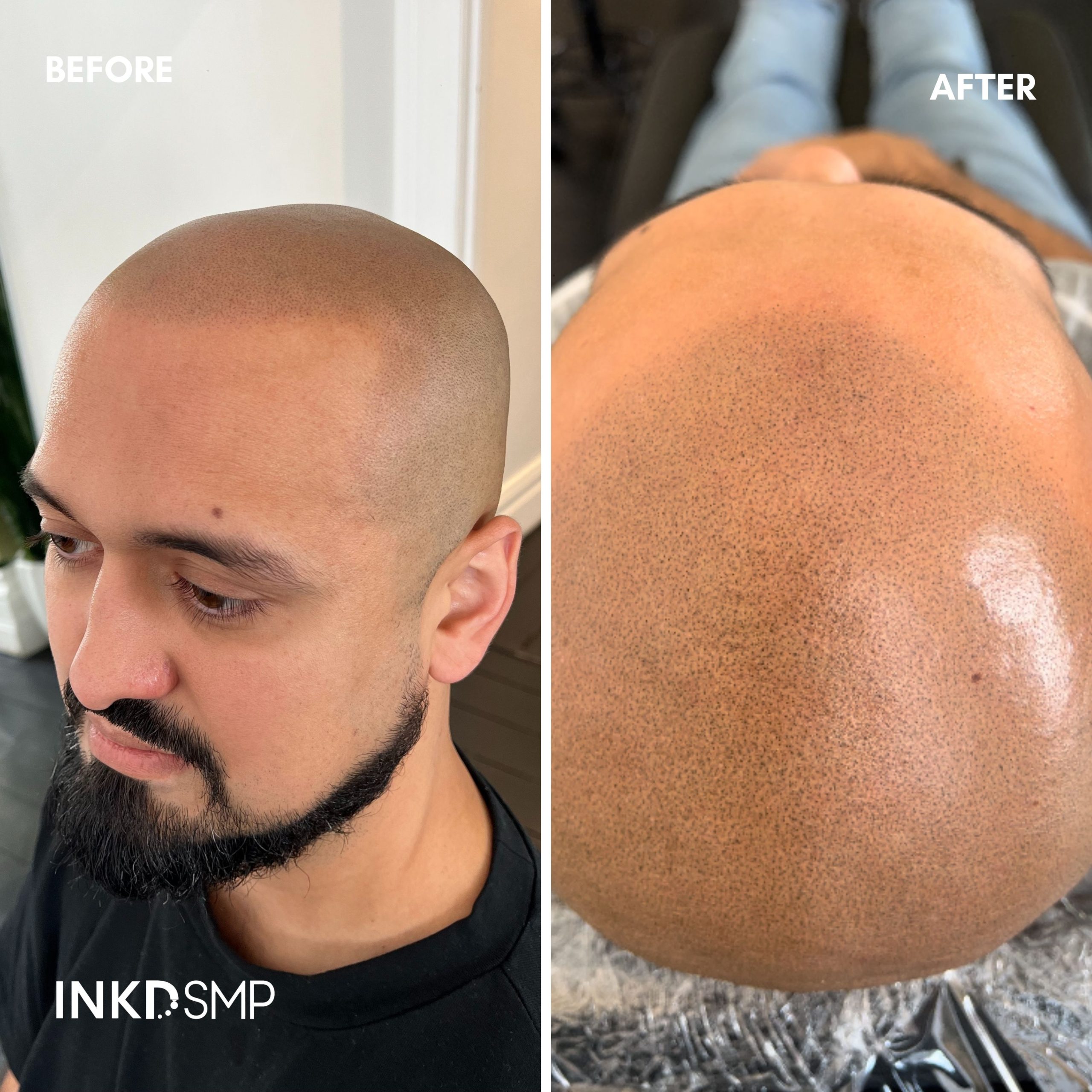 Why choose Inkd SMP Melbourne Hair Tattoo