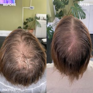 SMP Hair Thickening