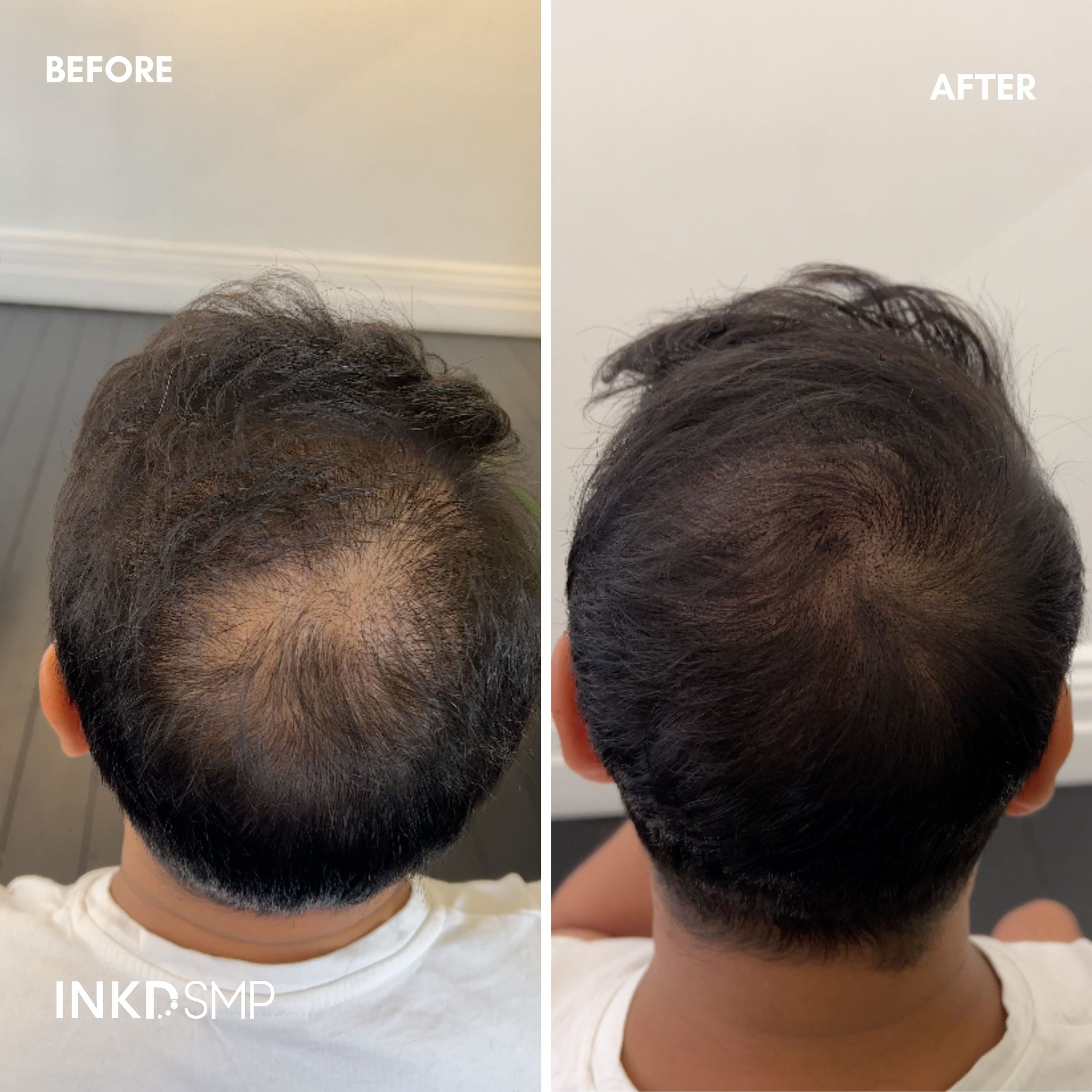 The Benefits of Scalp Micropigmentation: Beyond Cosmetic Enhancement