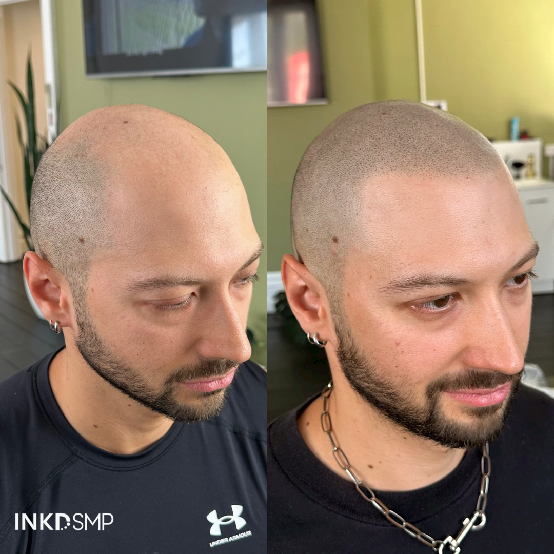 The Healing Process After Scalp Micropigmentation: What to Expect and How to Care for Your Scalp