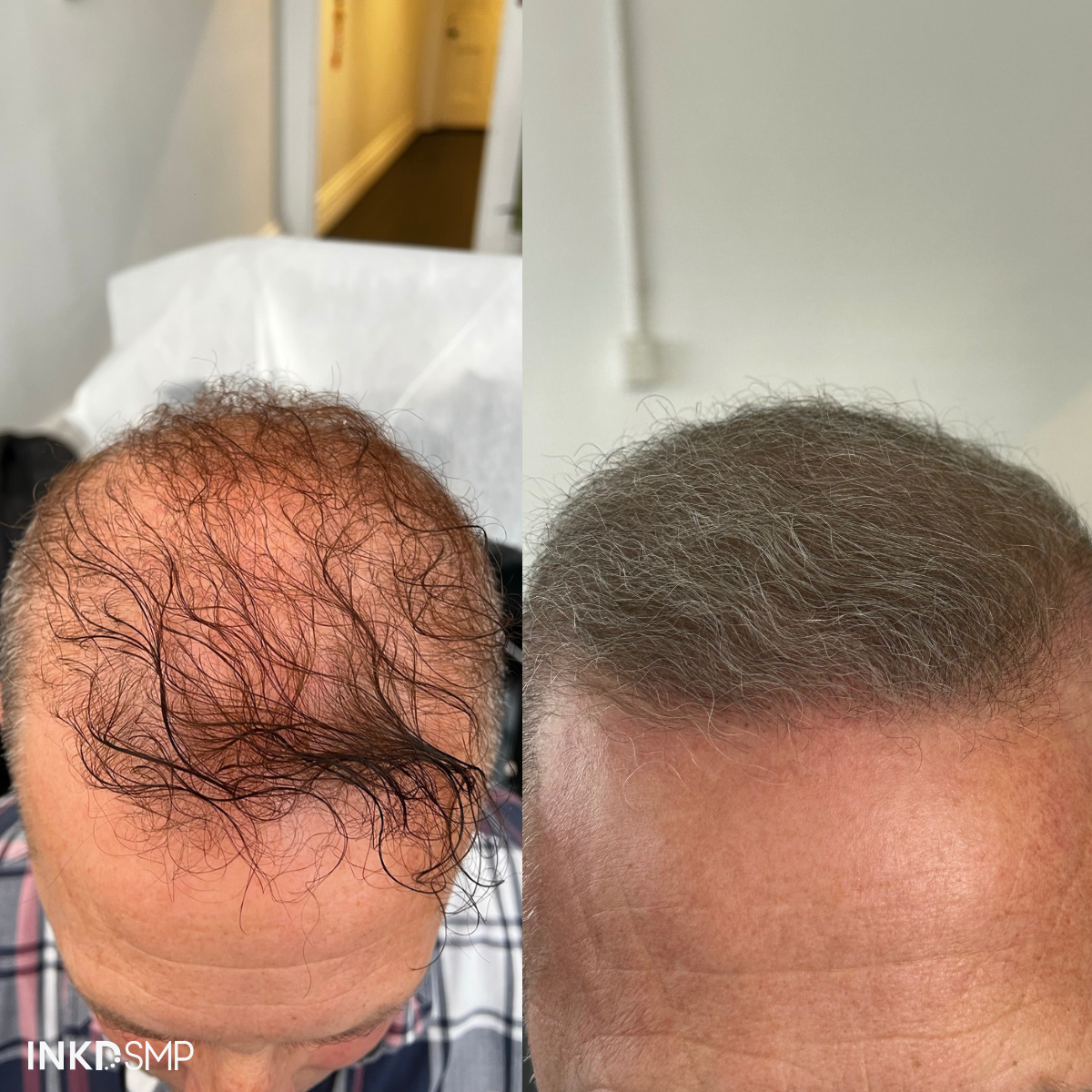 Hairline thickening melbourne