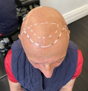 Alopecia