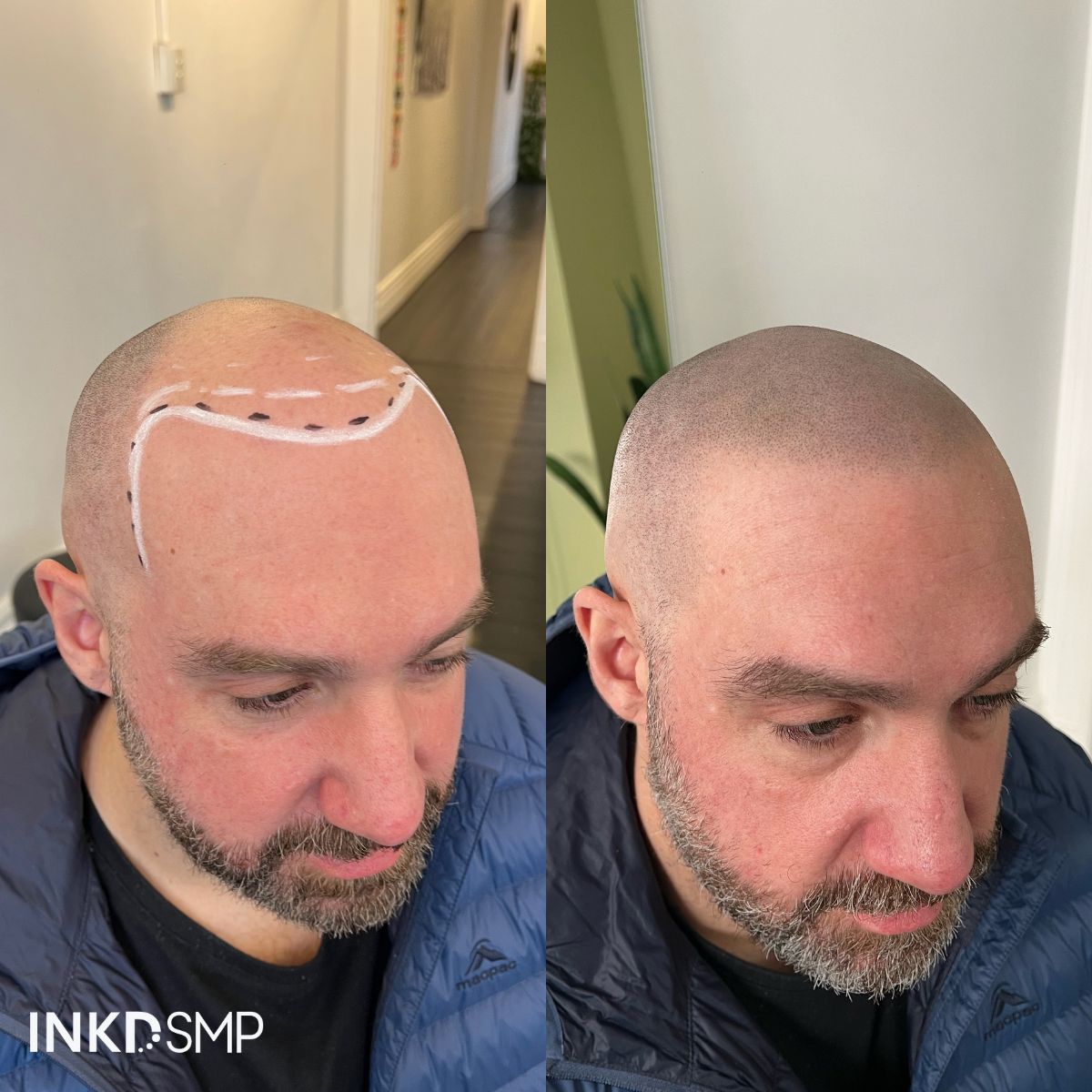 SMP After a Hair Transplant – Is It Okay?