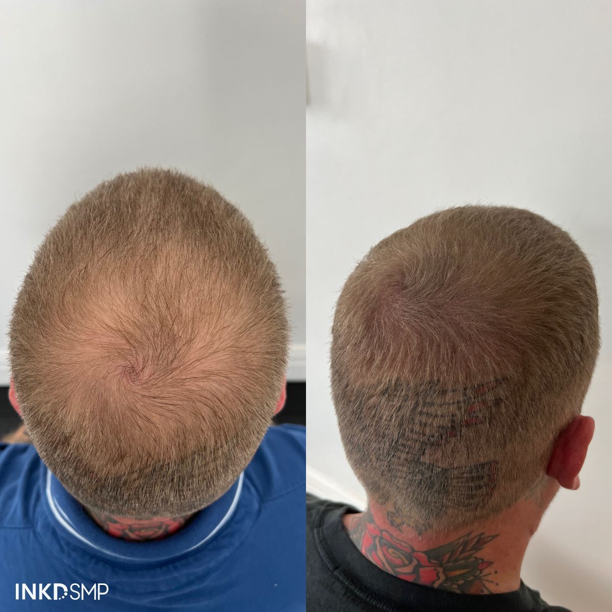 Hair Thickening Tattoo