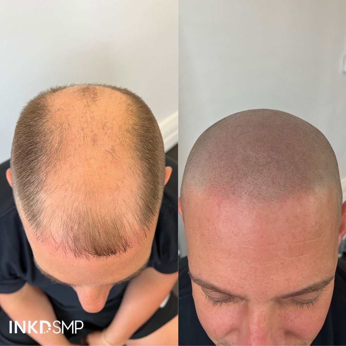 hairloss-tattoo-melbourne