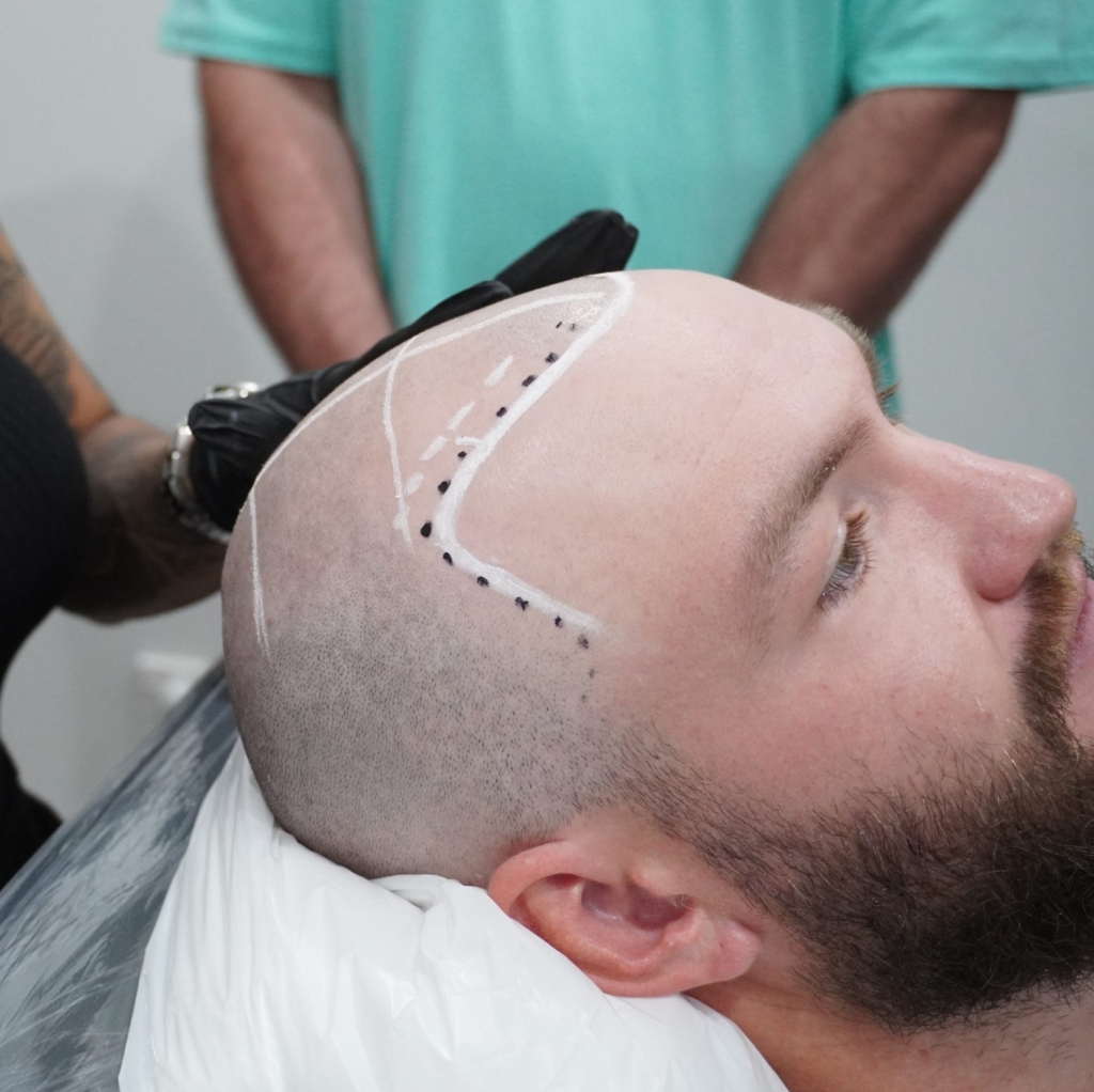 hairloss-Tattoo-melbourne