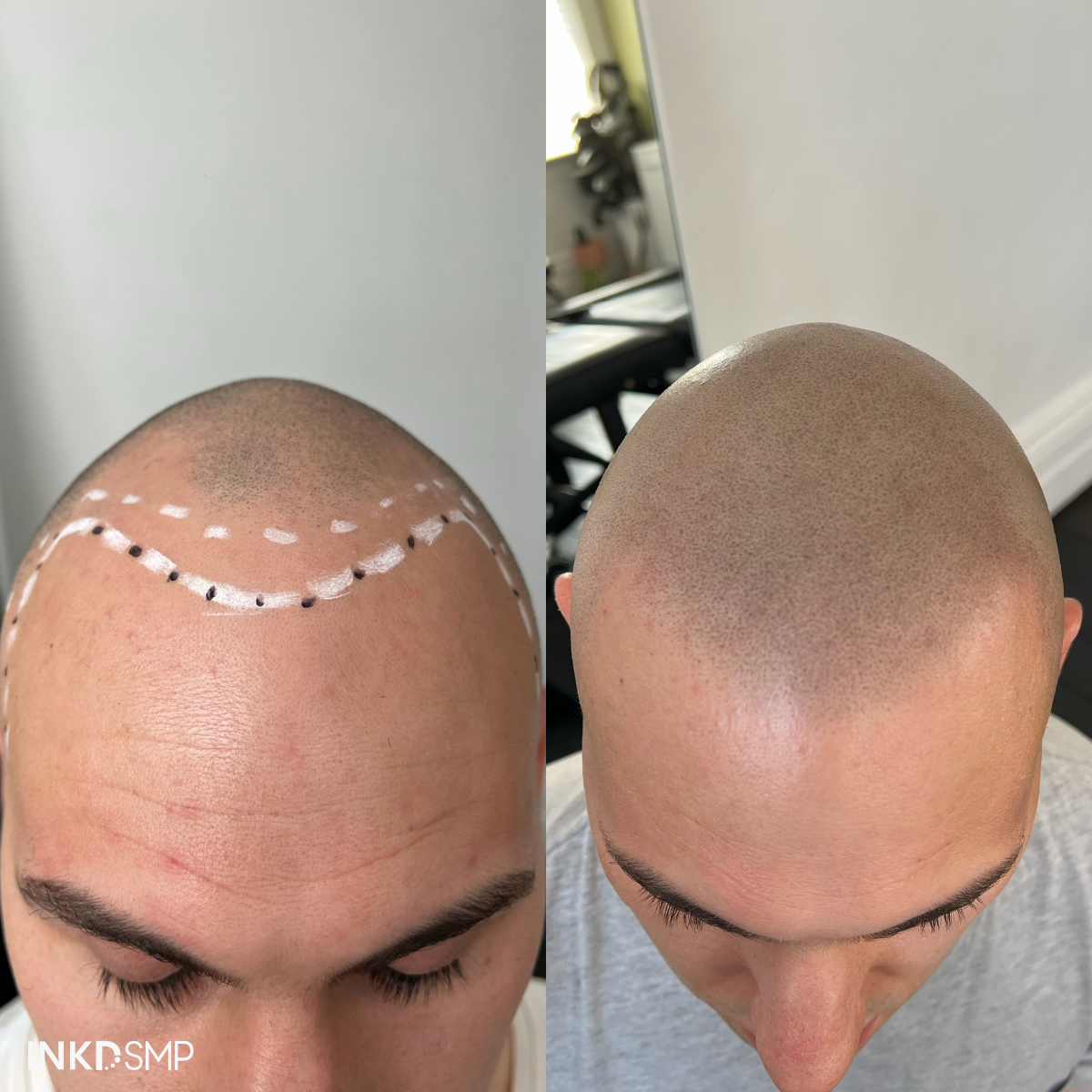 smp-hairline-tattoo-australia