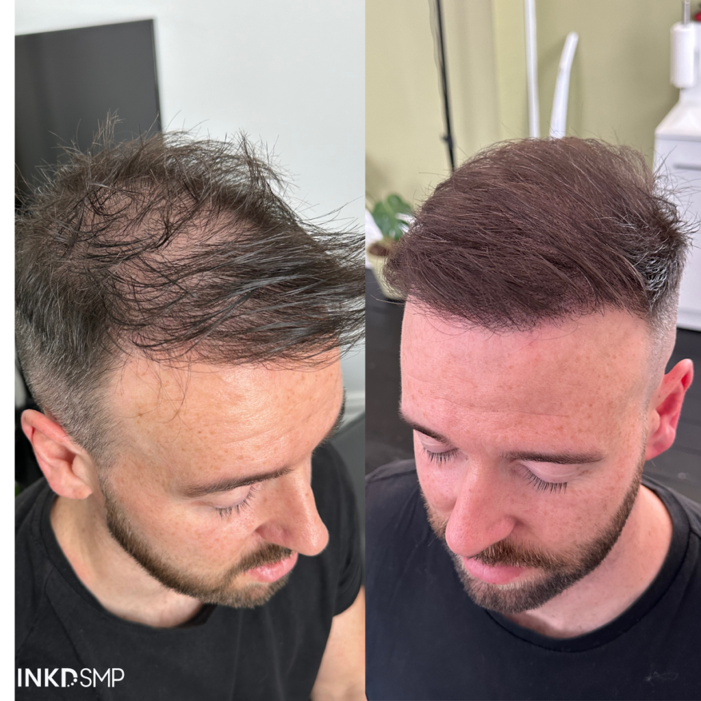 hair-transplant-tattoo-melbourne