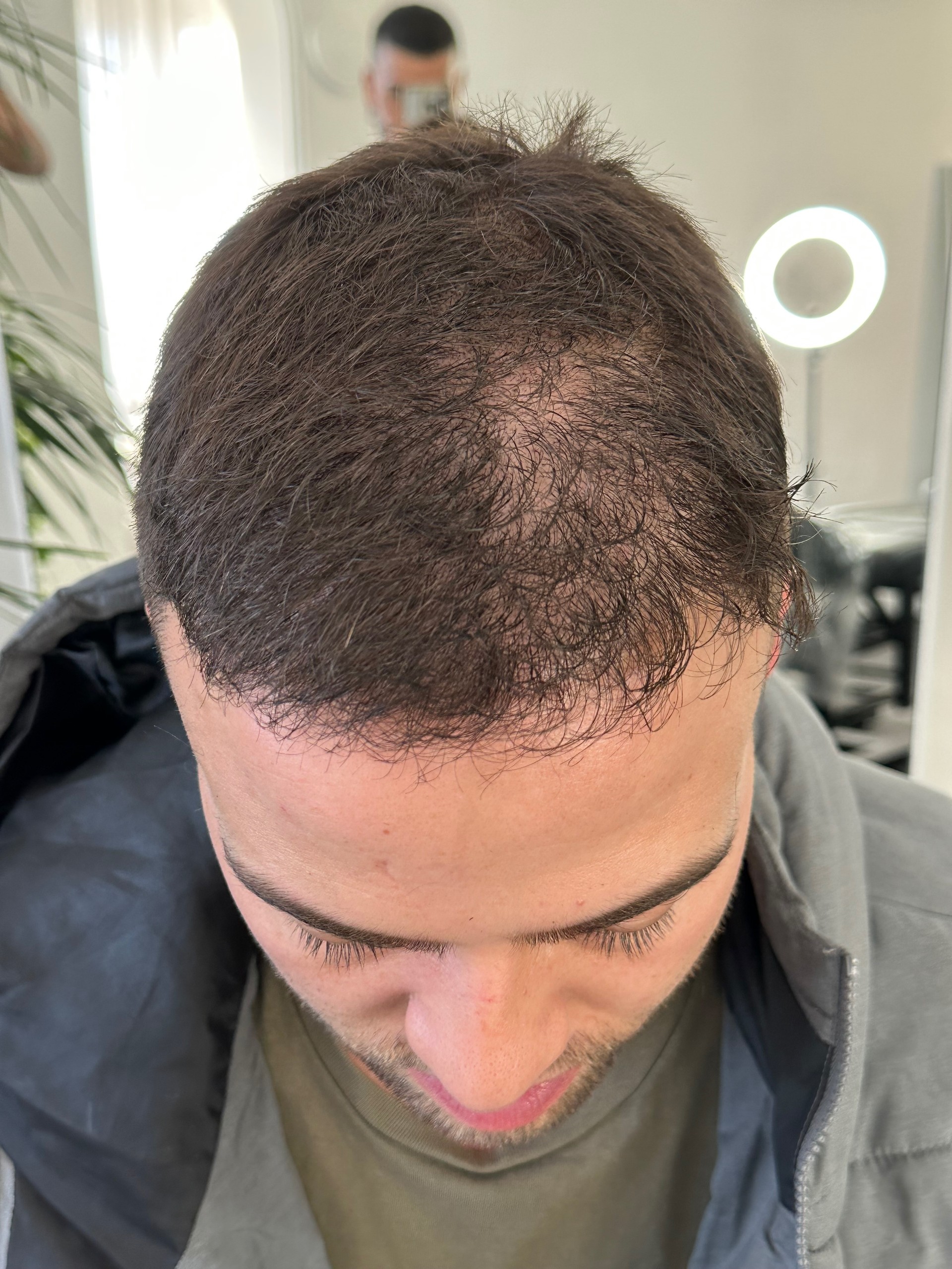 scalp-tattoo-melbourne