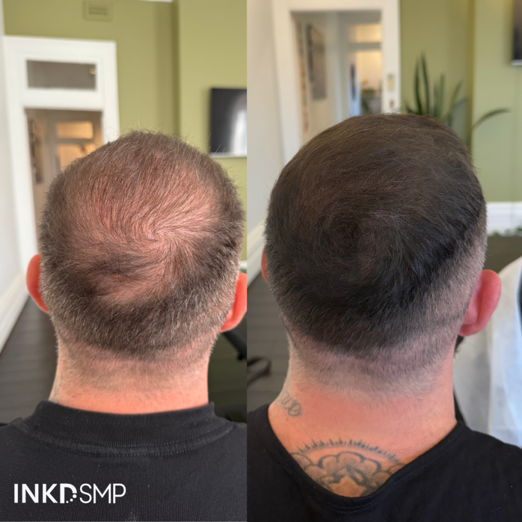 SMP-CROWN-THICKENING